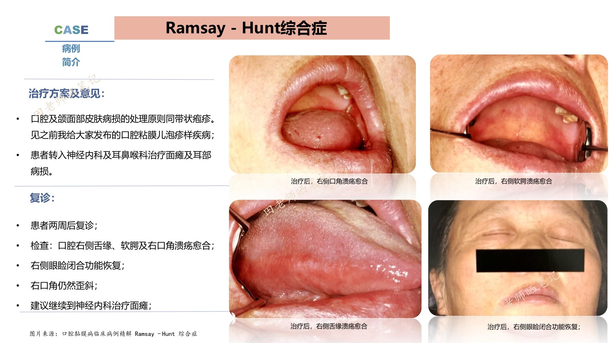 海兹默尔综合症 baijiahao.baidu.com