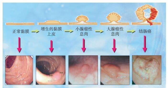 直肠息肉和痔疮的区别