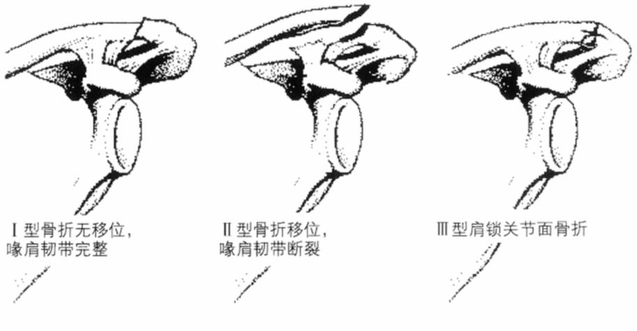 锁骨菱形窝:形态,功能及影像诊断全解析