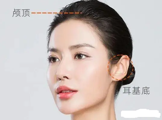 耳基底韧带提升—让你的耳朵更美更年轻