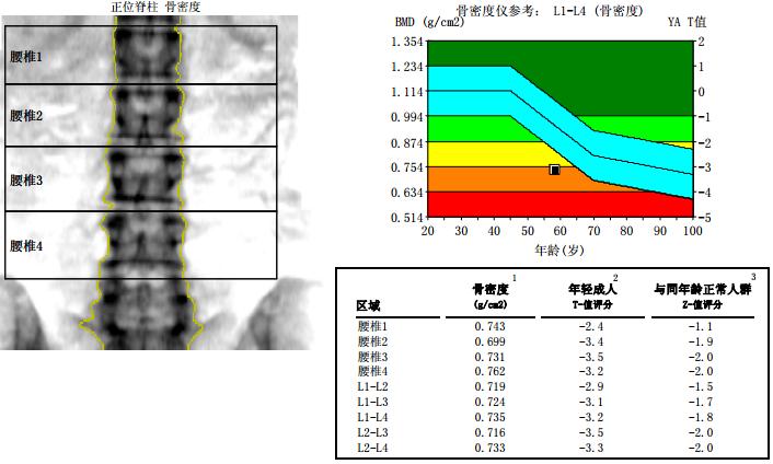 骨密度曲线图图片图片