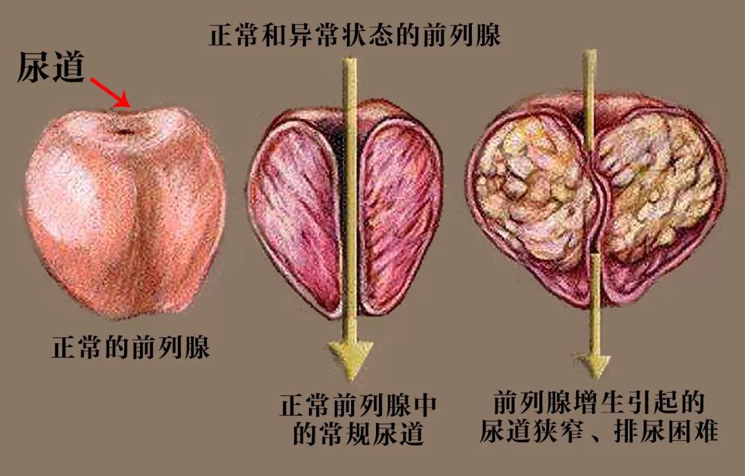 蒋孜明:不杀菌不消炎的中医,为何能治愈慢性前列腺炎?
