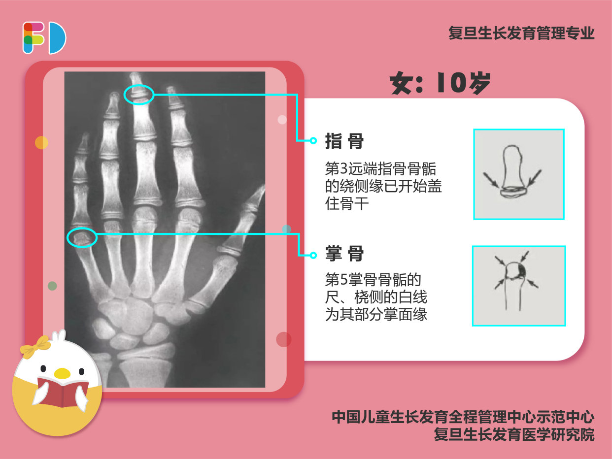 骨龄片怎么看?儿童骨龄对照表教你看懂儿童骨龄片