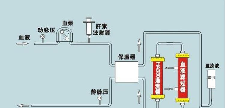 血液滤过联合血液灌流