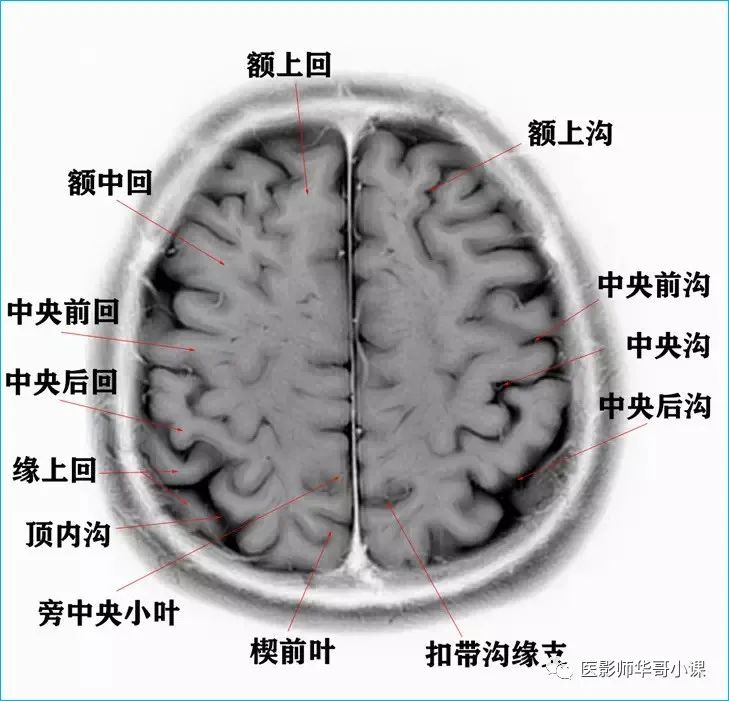 「高清mri图」颅脑磁共振mri解剖结构以及高清mr图谱