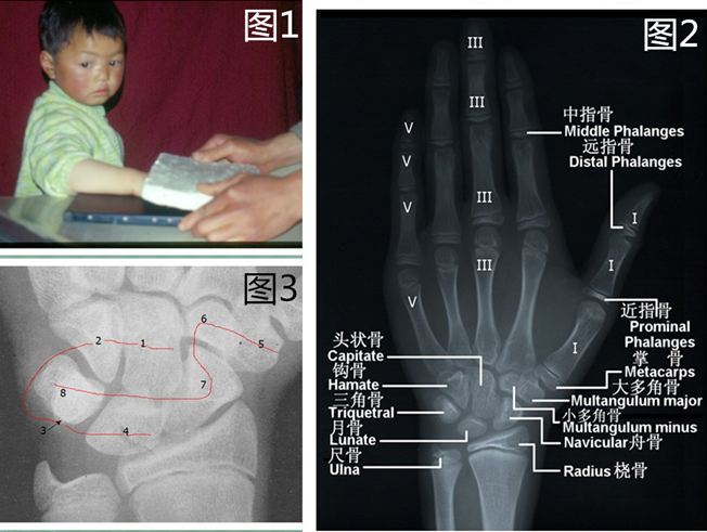 5～5 岁);月骨(3 岁左右);三角骨(2～2.