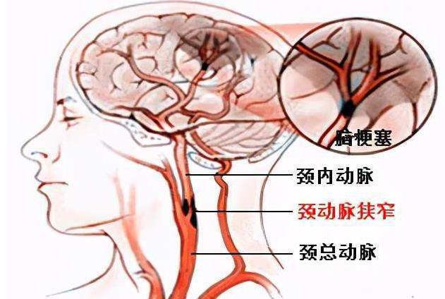 颈动脉的准确位置图片图片