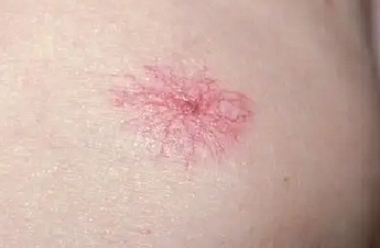 红色的蜘蛛痣是红色胎记吗?这是什么原因造成的