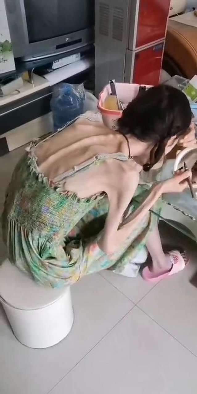 女子减肥成瘾患了厌食症,长期营养不良导致现在这个样子.
