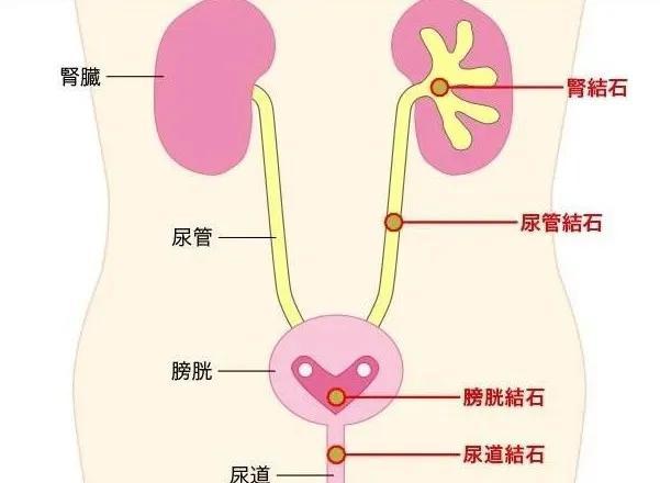 尿结石位置图片图片