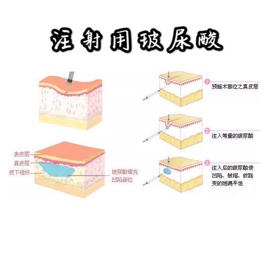 玻尿酸注射原理图片