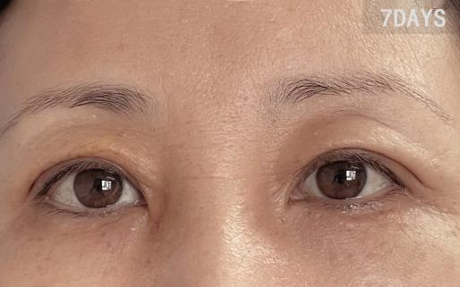 上眼皮松弛下垂怎么办?