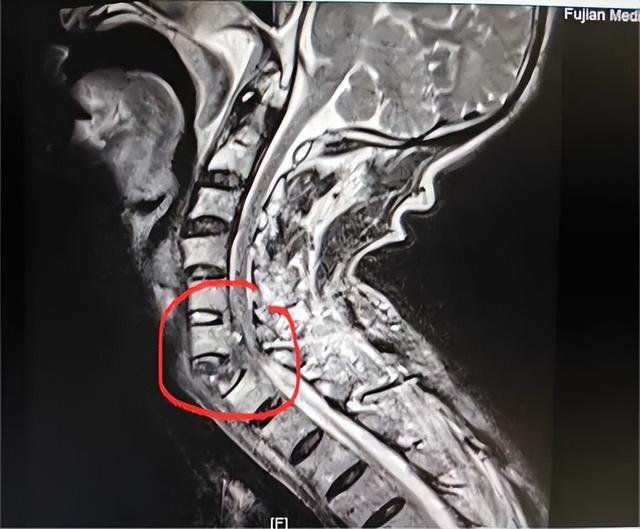 福州一男子颈椎骨折分离!幸好
