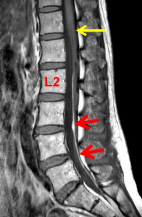 终丝脂肪沉积(fatty filum terminale)