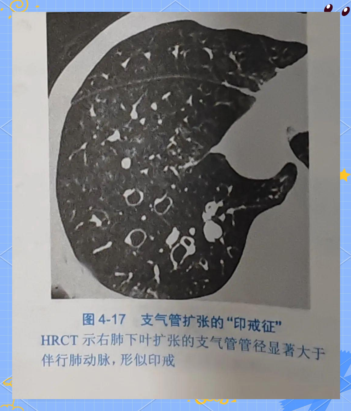 支气管扩张的特征与影像学诊断详解