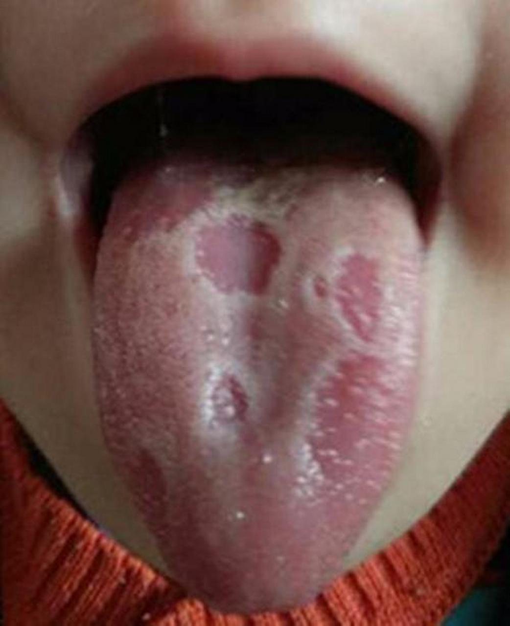 名词解释  【剥苔】    舌苔剥落.若苔长期剥蚀如地图状,多属虫积.