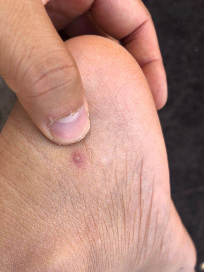 蔗农注意!下地干活一定要小心蚂蚁,被咬了后果很严重