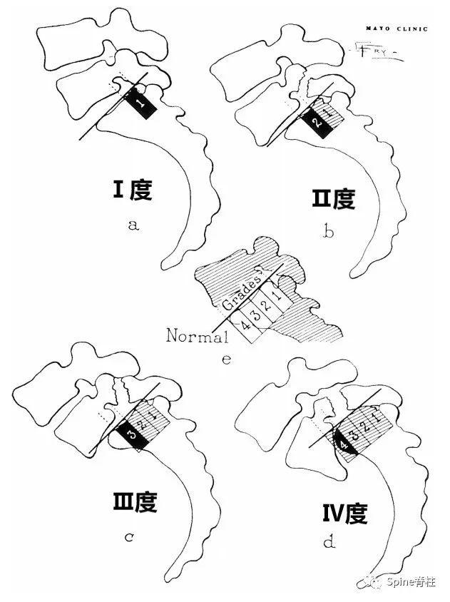 腰椎滑脱meyerding分级