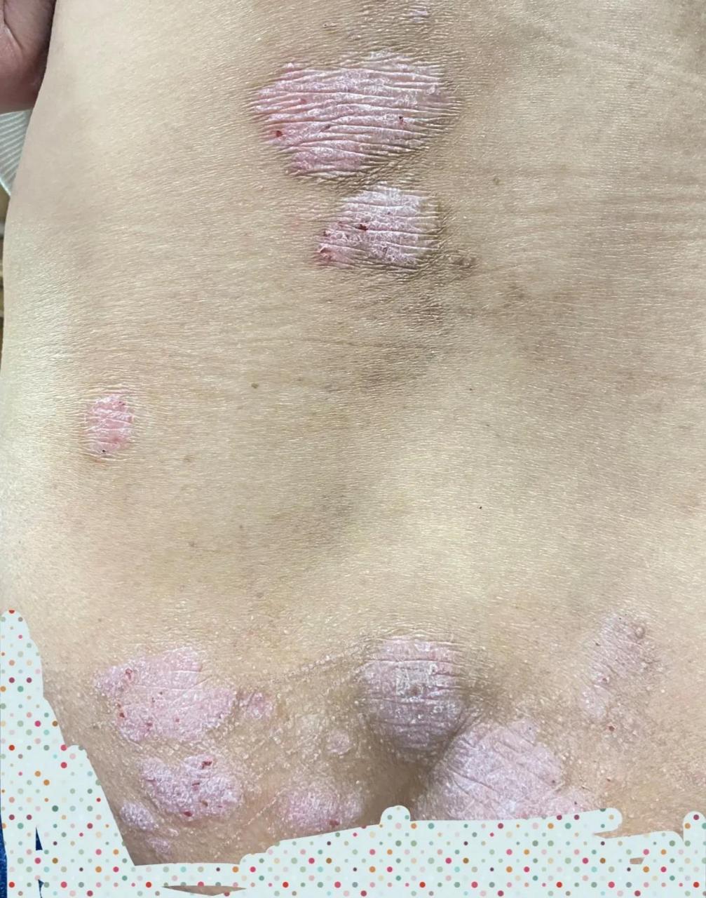 这种斑块型的银屑病皮疹比较难消.