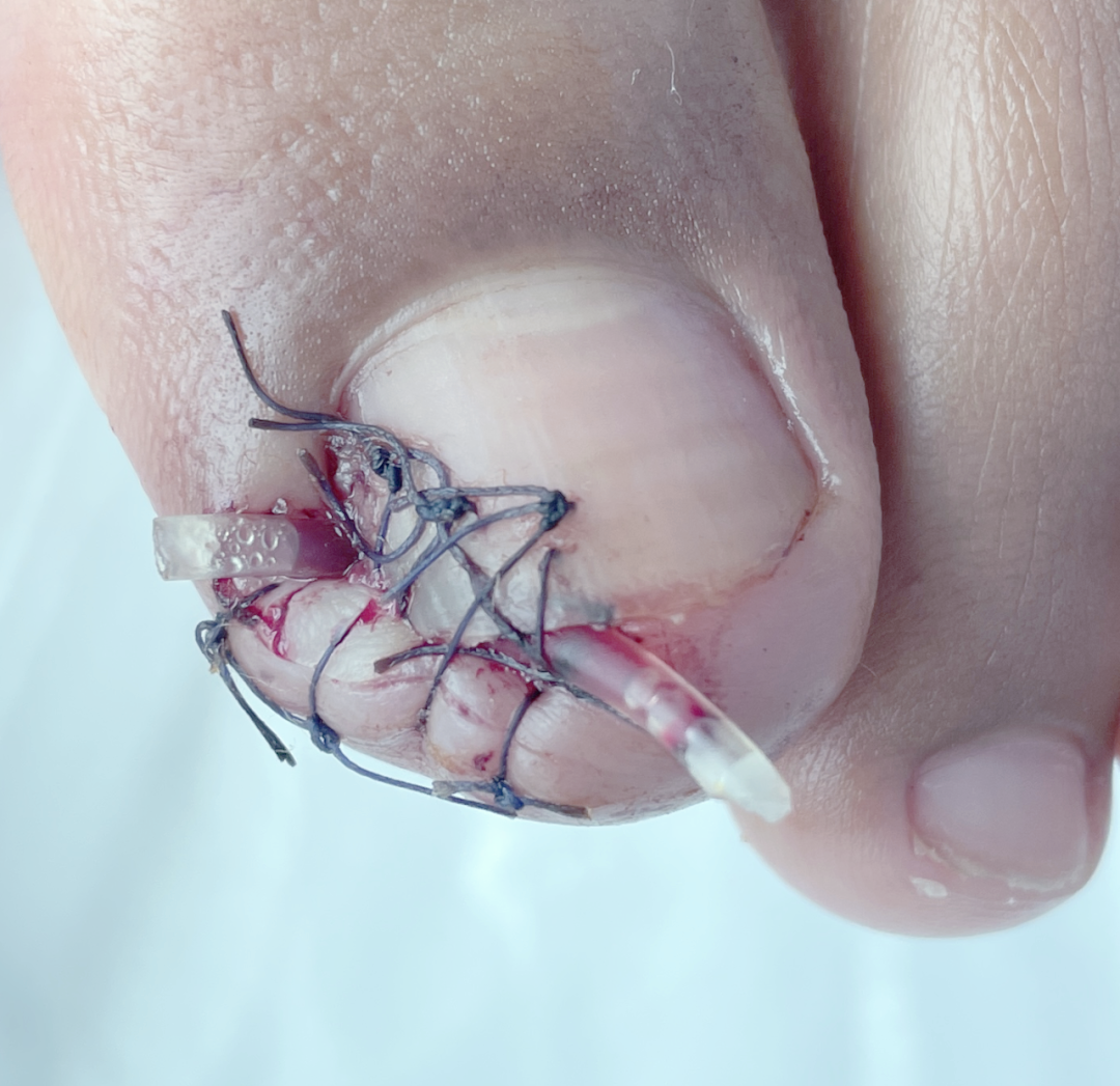 甲沟炎的痛苦:一种难以忍受的困扰