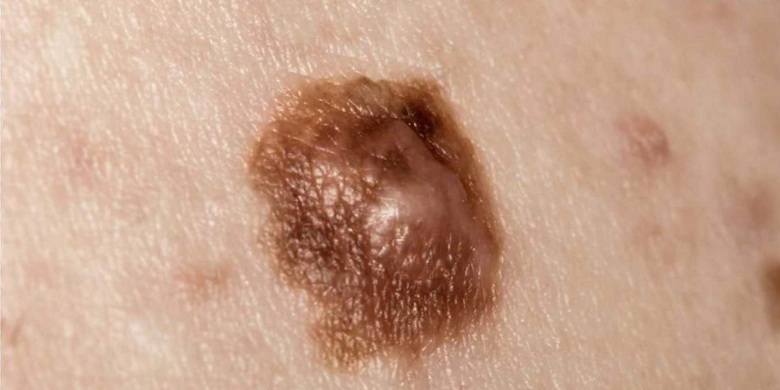 4种情况需警惕黑痣癌变#  身上的痣出现这4种情况,有癌变的风险!