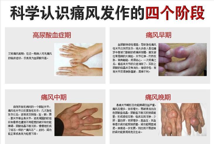 哪些人容易实现痛风临床治愈?