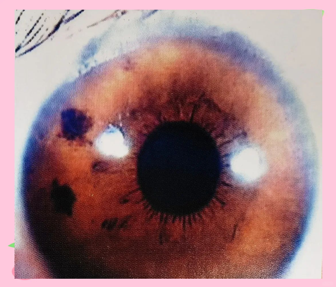 从虹膜解读健康:颜色与特征的奥秘