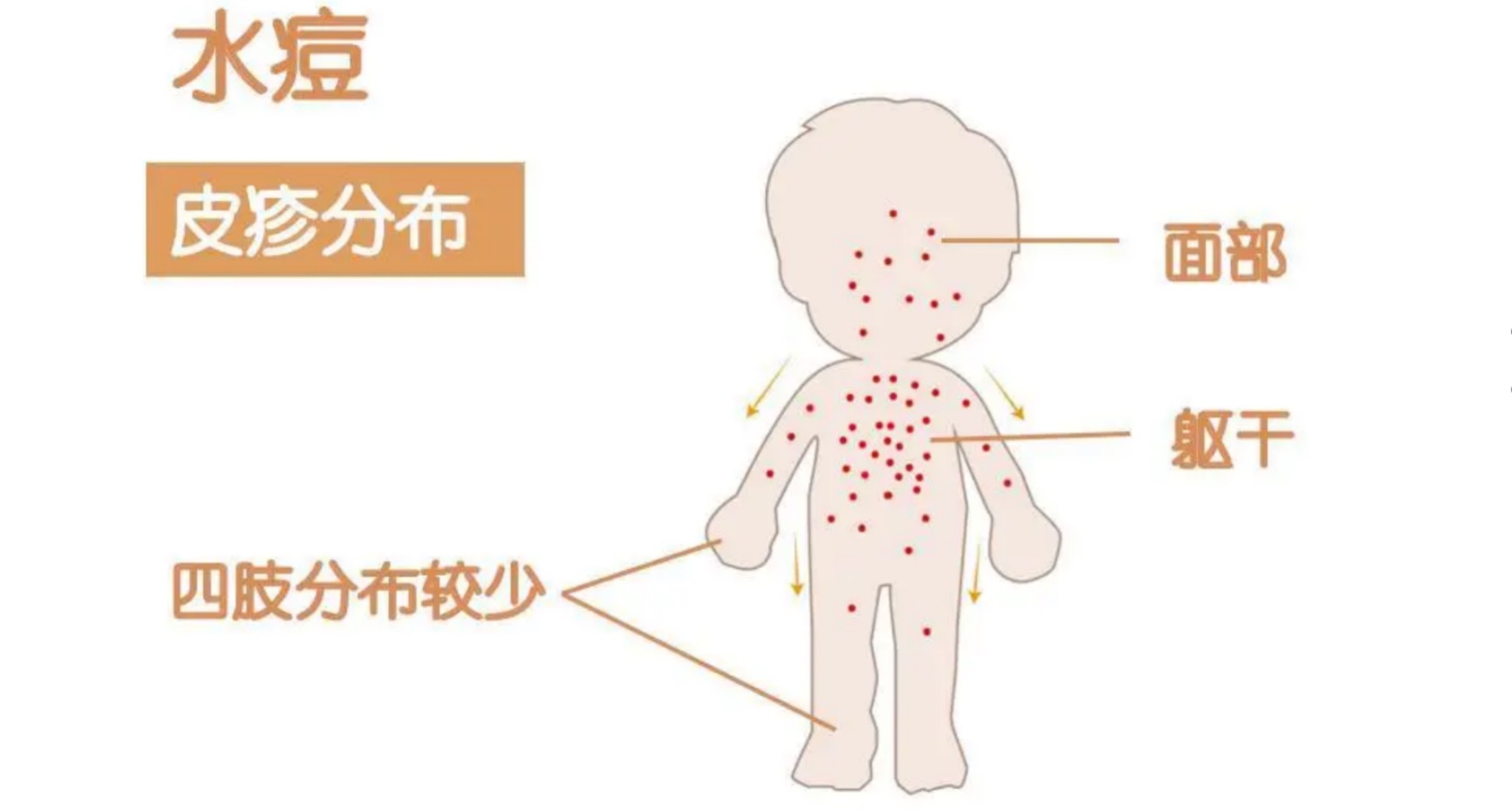 儿童高发的水痘