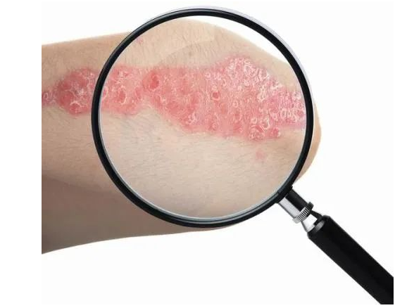 辨证血燥型银屑病治疗,不要盲目乱治!