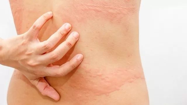 挠痒痒会传染?为什么皮肤会越抓越痒?
