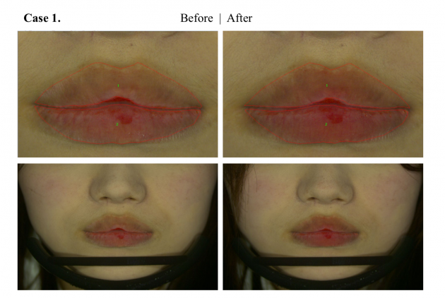 NARCI美唇仪——永远告别干裂嘴，还你天然水润嘟嘟唇