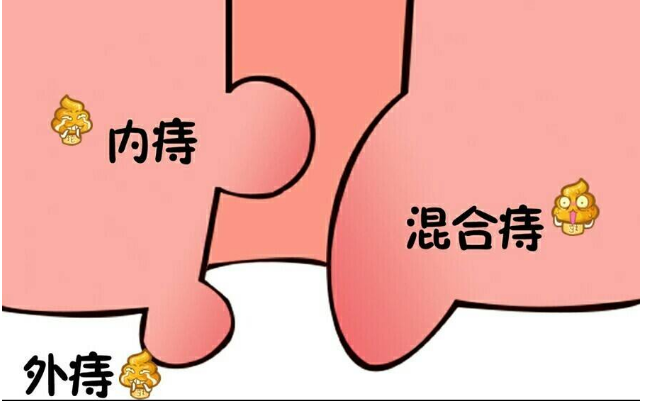 痔疮外痔肉球用什么药能快速消除?三个小窍门,菊花舒服多了