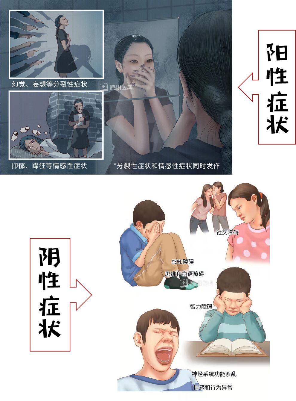 精神分列症是怎样的(精神分列症典型症状)