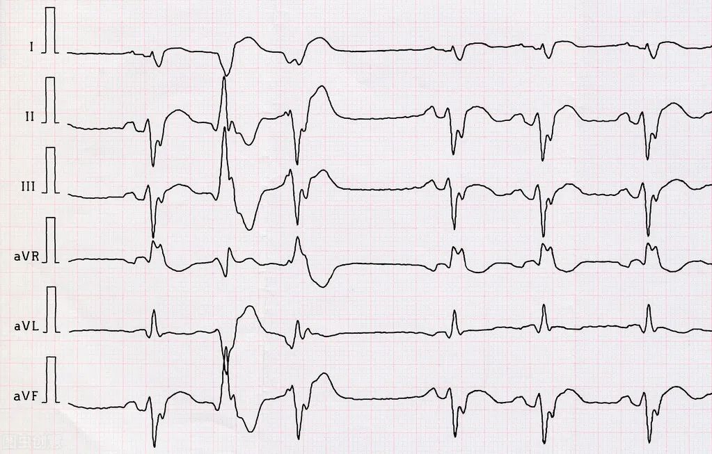 心电图电压高图片