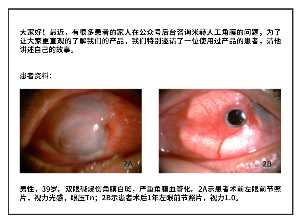 患者自述:如果没有米赫人工角膜,我不知道自己会变成什么样子