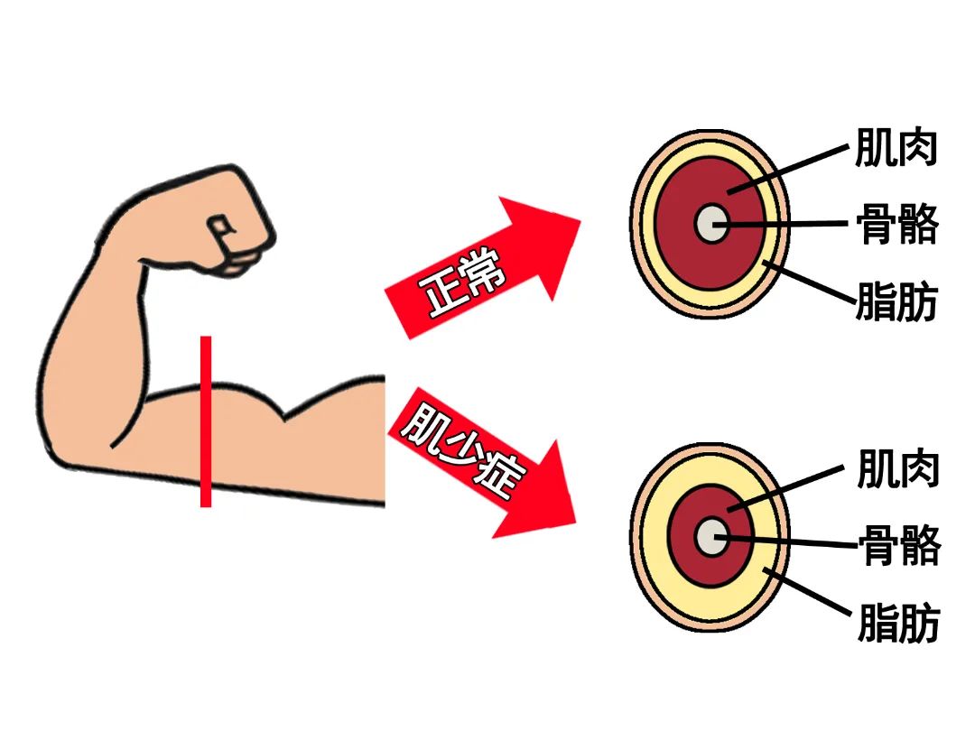 【科普工作委员会】肌少症丨老年人群中静悄悄的疾病