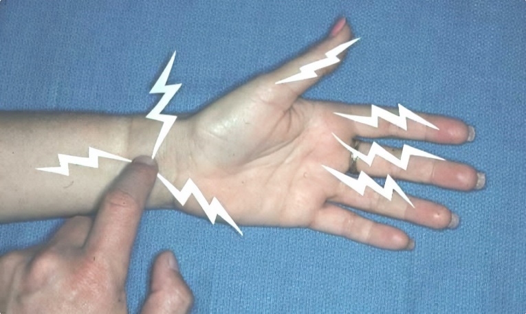 手麻不一定是颈椎病,腕管综合征也是常见病!