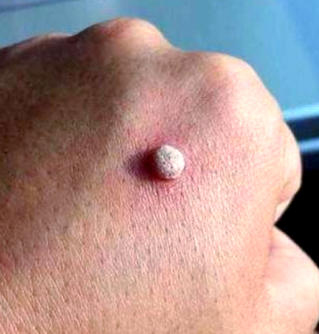 身上出现肉瘊子是怎么回事?肉瘊子如何处理?