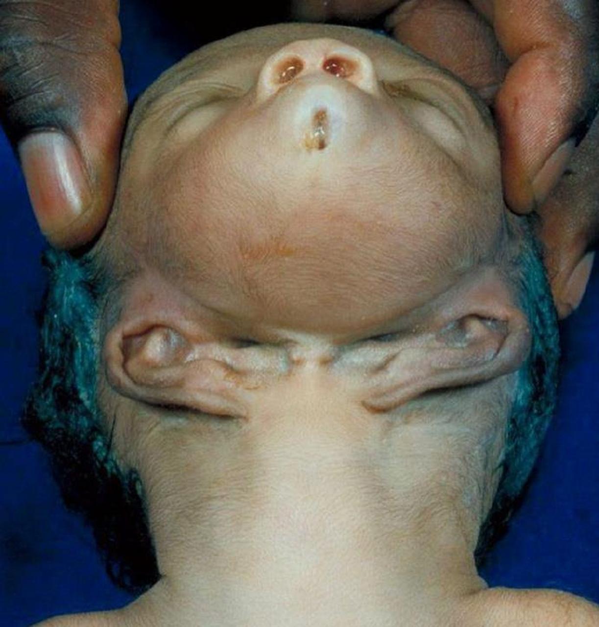 这张照片的对象是一个患有头部畸形的婴儿,这是一种罕见的遗传疾病,每