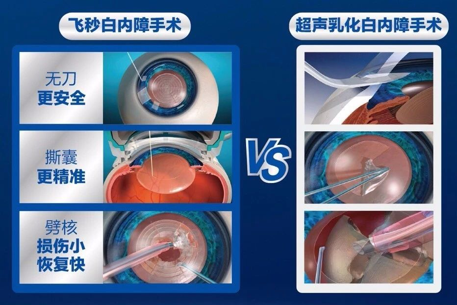 白内障手术费多少钱图片