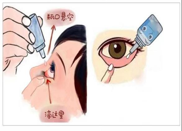 "滴眼药水"这事儿,你确定你真的会?