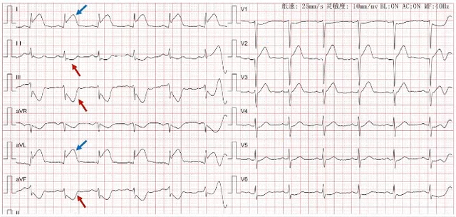 stemi305图片