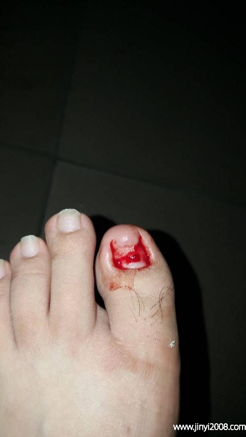 脚趾甲被砸了脱落多久能走(脚趾骨折可以用脚后跟走路吗)