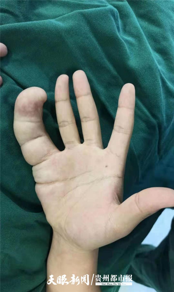 18岁少年患罕见巨指症,小指大如香肠