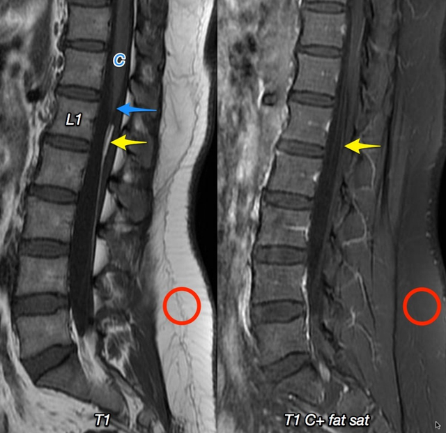 终丝脂肪沉积(fatty filum terminale)