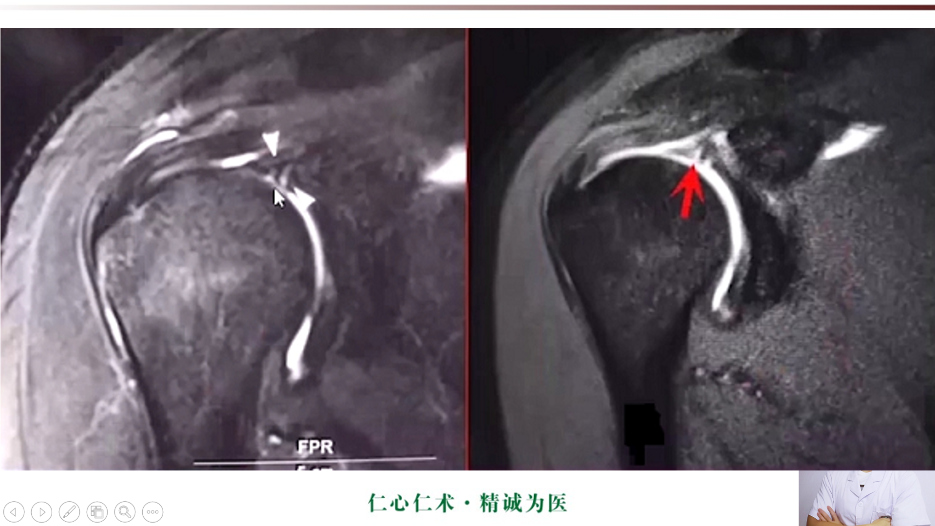 盂肱韧带mri解剖图片