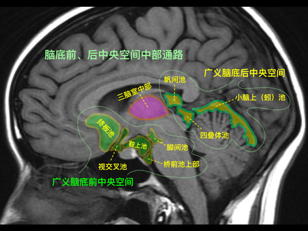 垂体柄解剖图磁共振图片