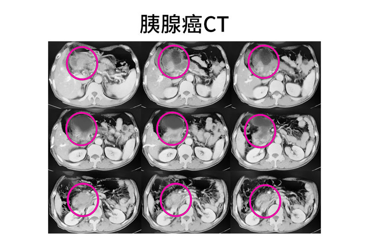 胰腺癌晚期再添治疗新利器 不开刀