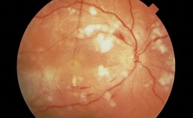 甲状腺眼病是什么原因导致的?