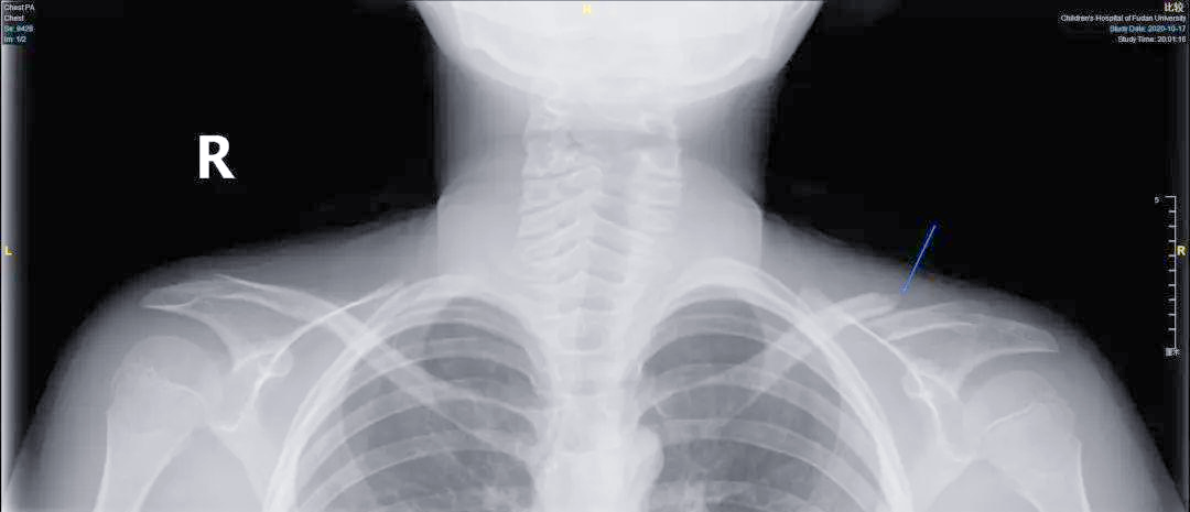 锁骨骨折的诊断与治疗全解析